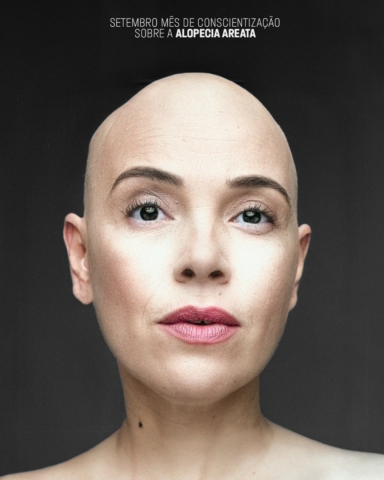 Setembro é o mês da Alopecia Areata